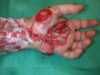 Järeemmät tikkaukset